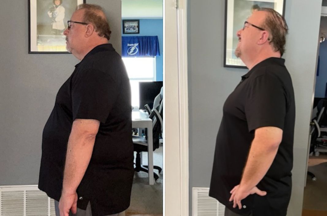 Big Rig of 99.3 The Fox Rocks before and after weight loss treatment